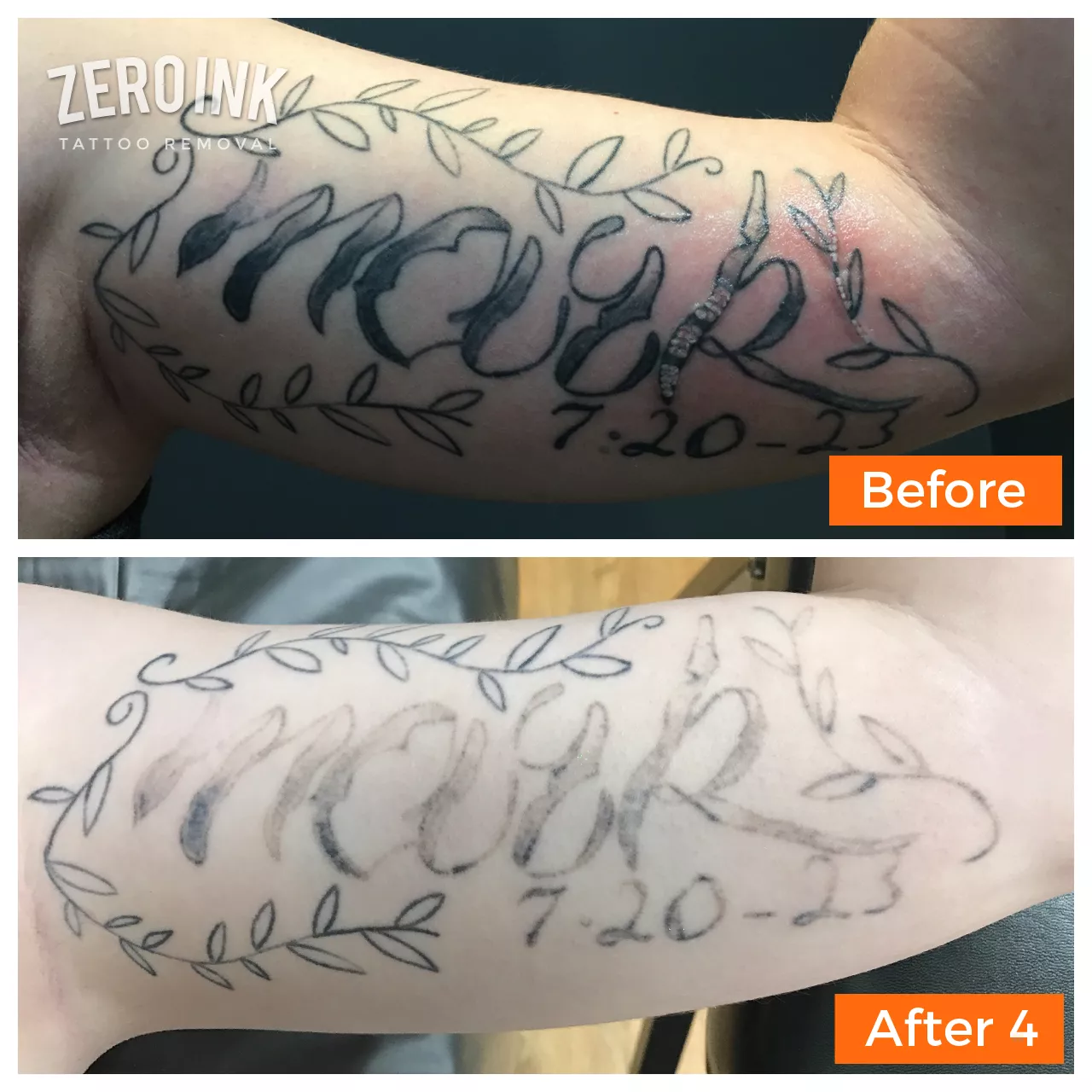HomePage Zero Ink Tattoo Removal